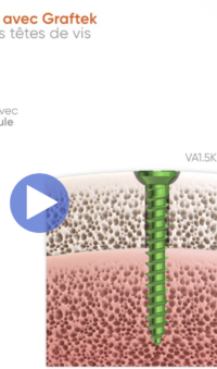 Tutoriel - Régénération Osseuse Ostéosynthèse Graftek