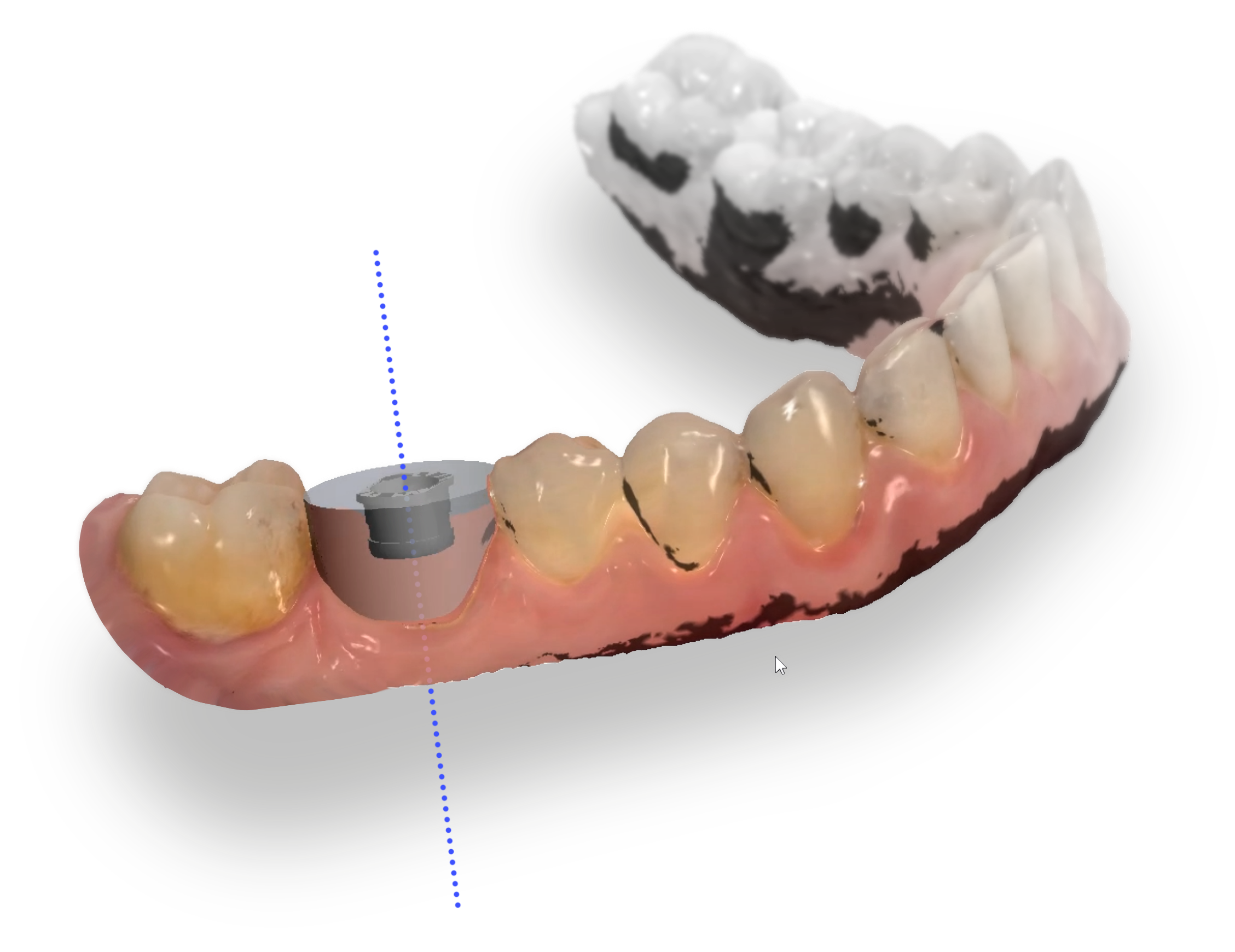 Arch CAD_Guided Surgery