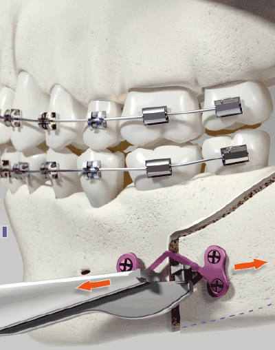 Positionnement d'une plaque à réglage sur site Ortrautek