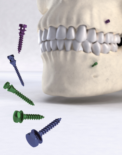 Mini-vis d'ancrage orthodontique Ancotek sur site