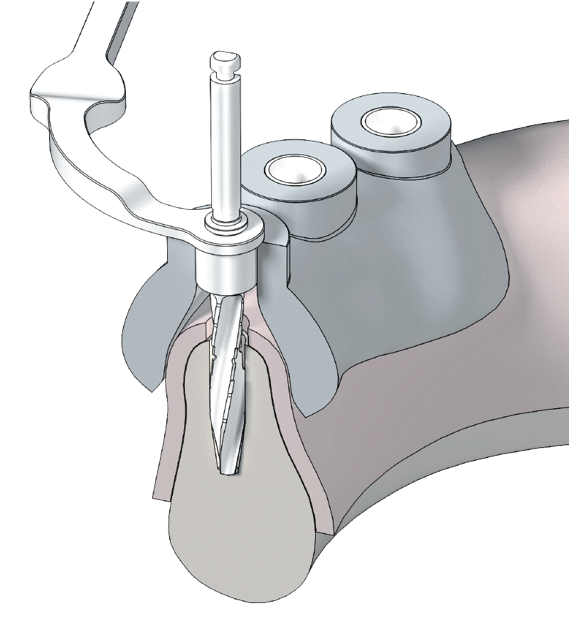 Utilisation d'une cuillère - Trousse de Chirurgie Guidée UTIMATE