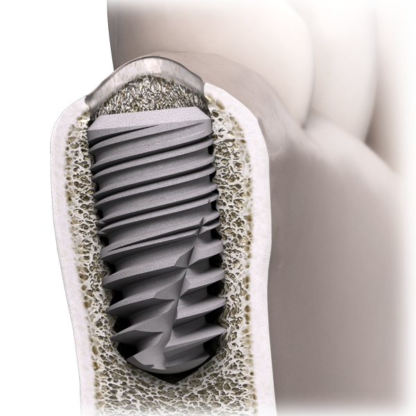 Os Cortical - In-Kone® sur site